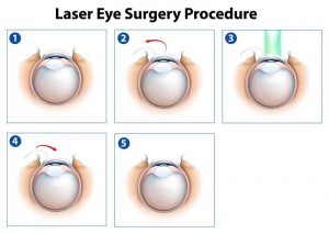Lasik Surgery Process