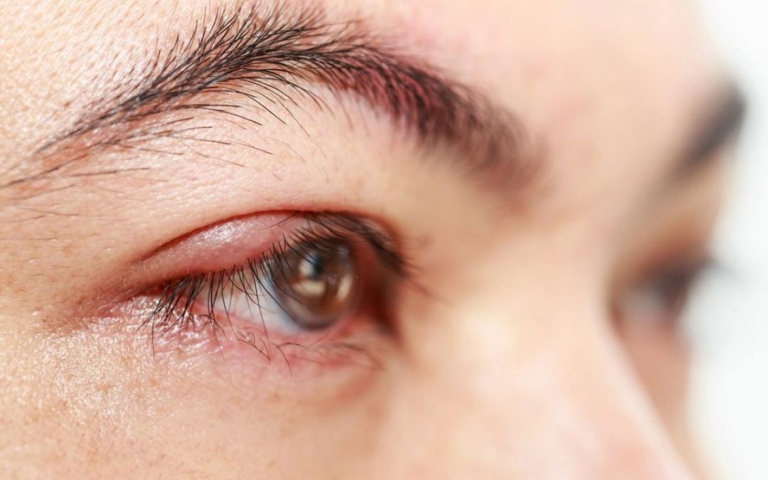 Are Your Eyelashes Infested With Mites? Stop Scratching For A Minute To Find Out!
