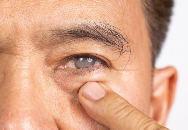 How Do RLE and LASIK Differ Image