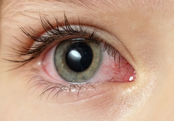 Potential RLE Complications Image